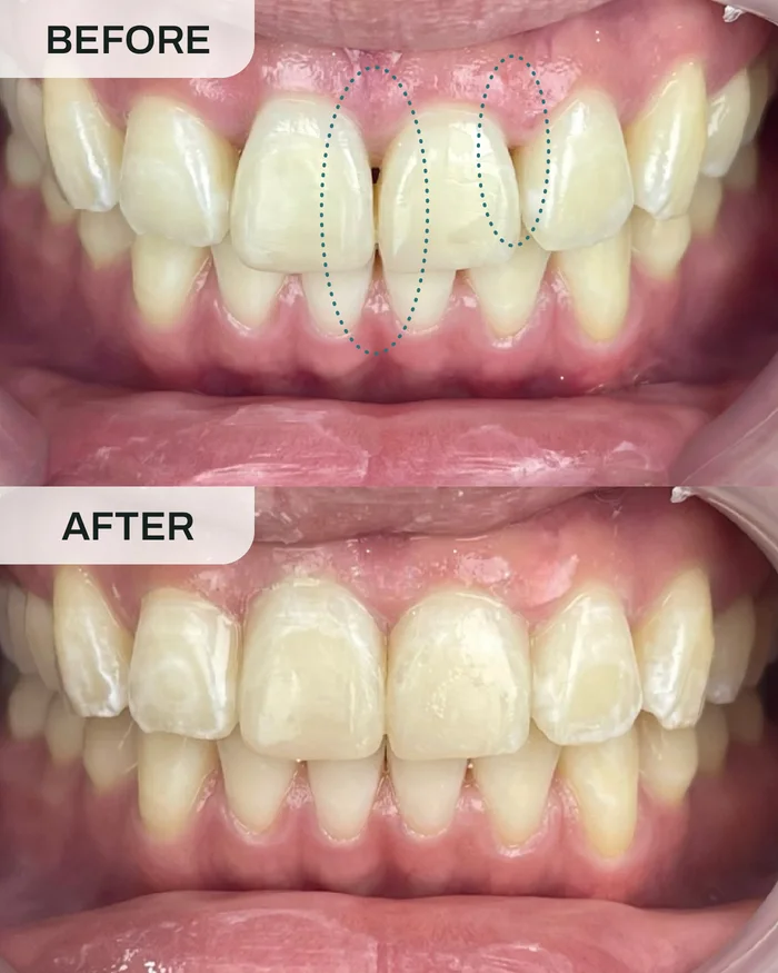 Black Triangle Closure before and after result at Ivory Dental Kepong