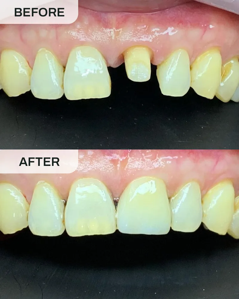 Crowns and bridges before and after, case 2, at Ivory Dental Kepong