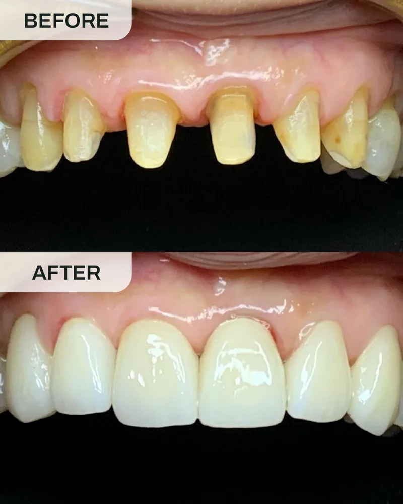 Crowns and bridges before and after, case 3, at Ivory Dental Kepong