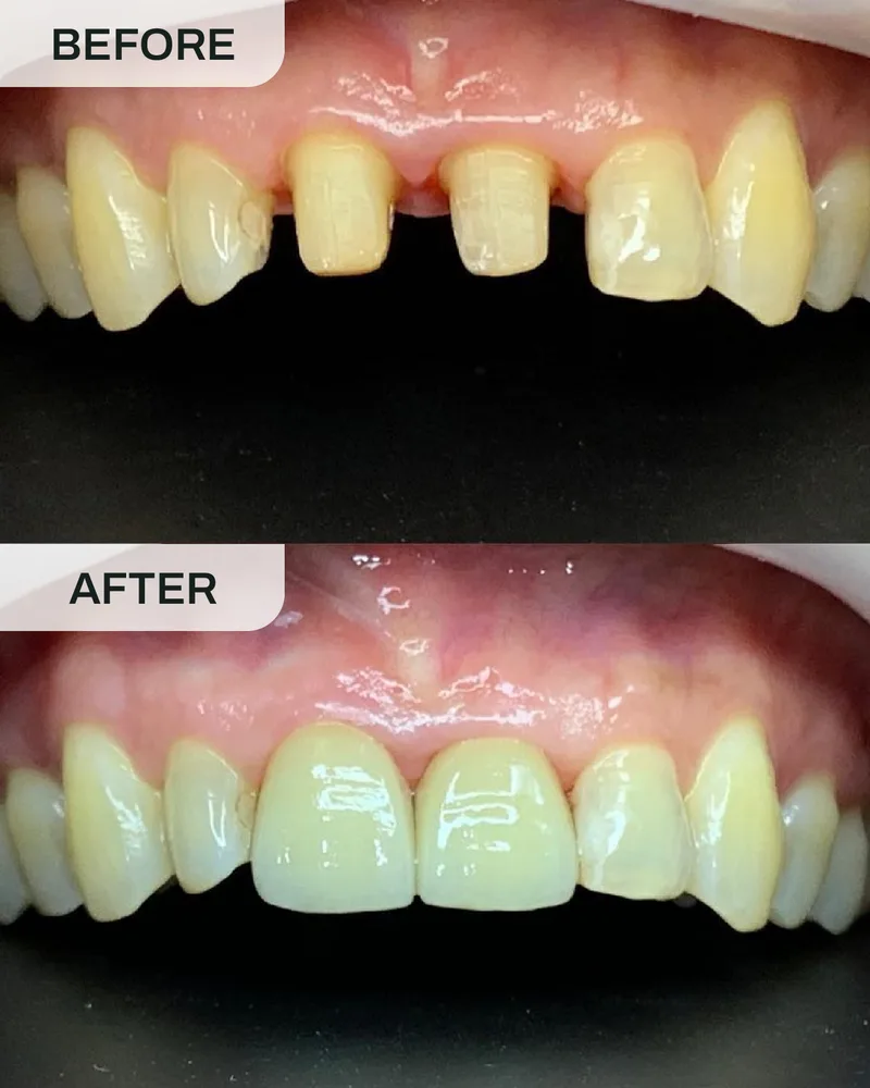Crowns and bridges before and after, case 4, at Ivory Dental Kepong