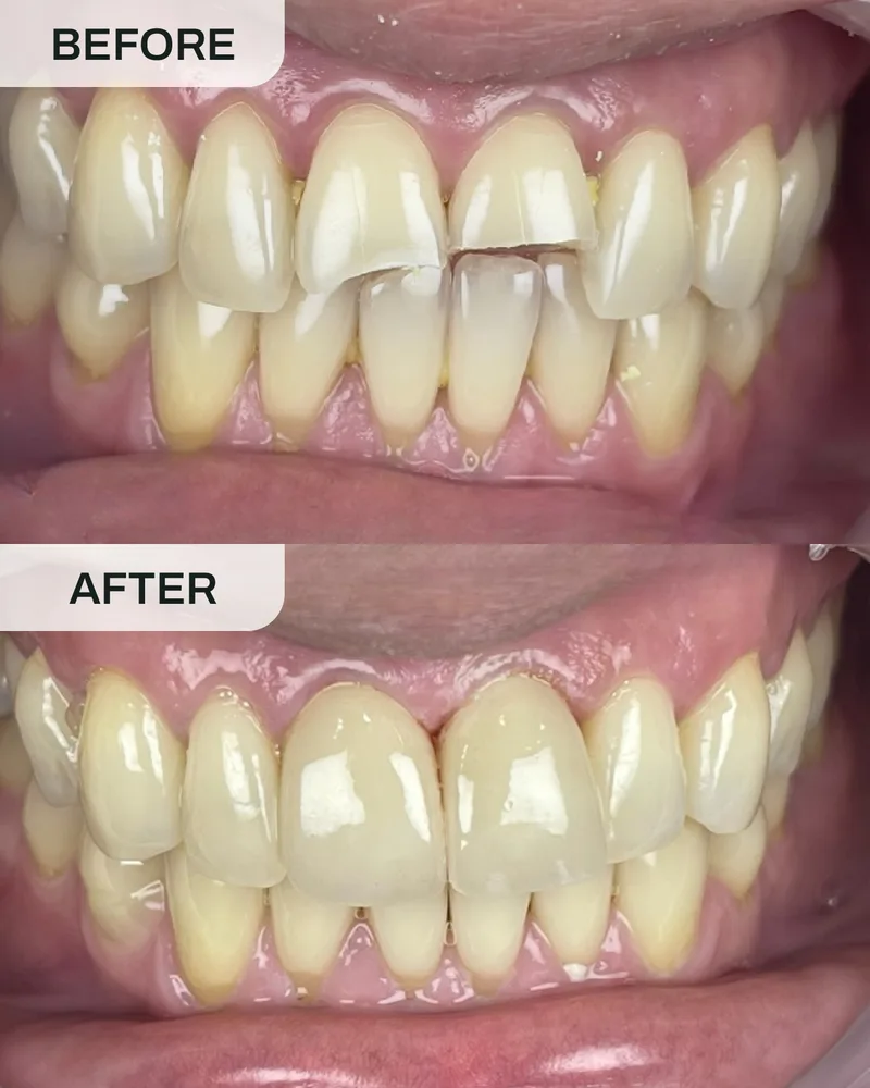 Crowns and bridges before and after, case 5, at Ivory Dental Kepong