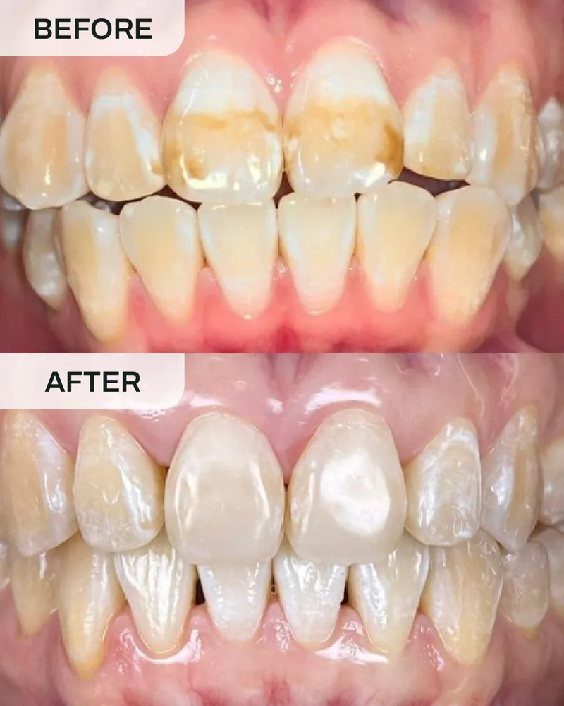 Crowns and bridges before and after, case 6, at Ivory Dental Kepong