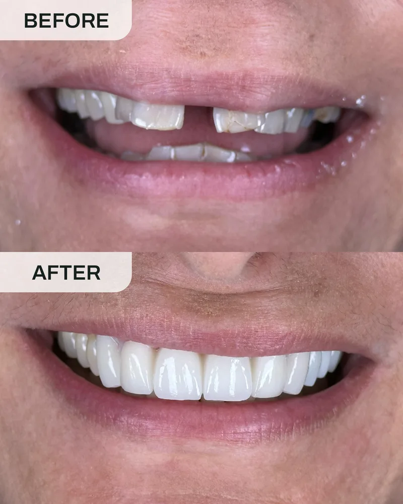 Crowns and bridges before and after, case 7, at Ivory Dental Kepong