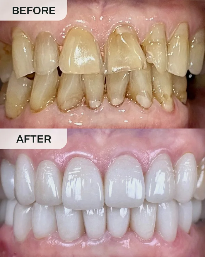 Crowns before and after result at Ivory Dental Kepong