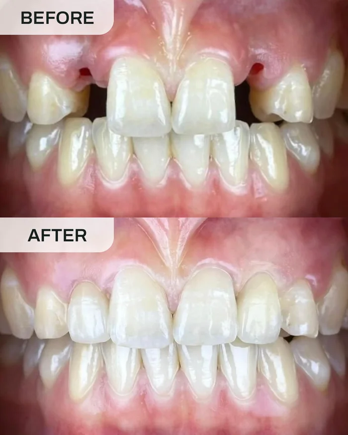 Dental Implants before and after result at Ivory Dental Kepong