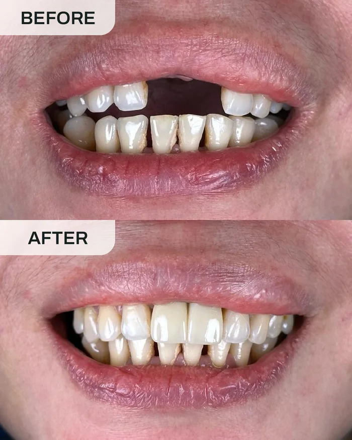 Dental Implants before and after result at Ivory Dental Kepong