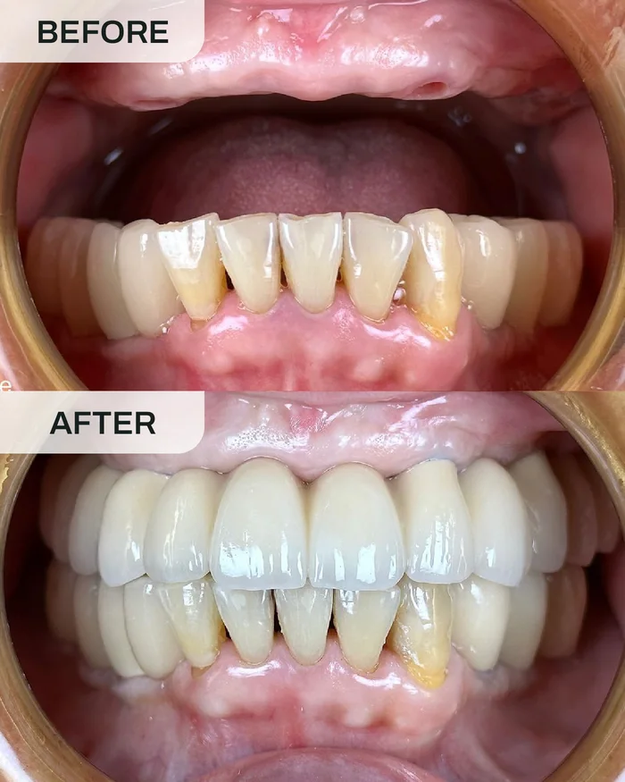 Dental Implants before and after result at Ivory Dental Kepong