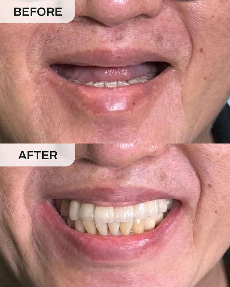 Dental implant before and after, case 4, at Ivory Dental Kepong