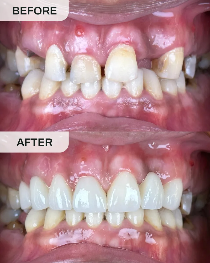 Dental implant before and after, case 5, at Ivory Dental Kepong