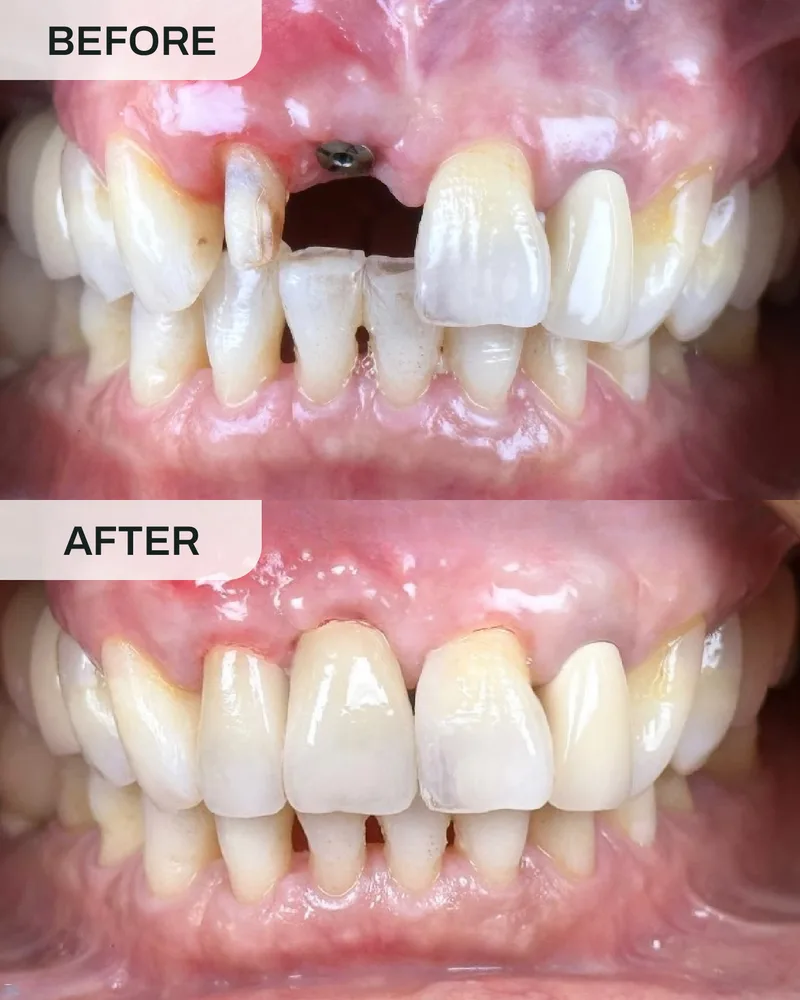 Dental implant before and after, case 6, at Ivory Dental Kepong