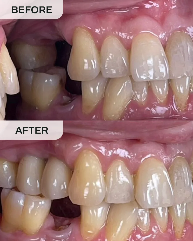 Dental implant before and after, case 7, at Ivory Dental Kepong