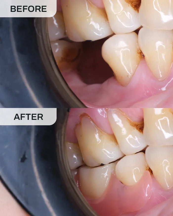 Flexi Denture before and after result at Ivory Dental Kepong