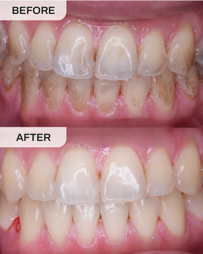 Scaling & Polishing before and after result at Ivory Dental Kepong