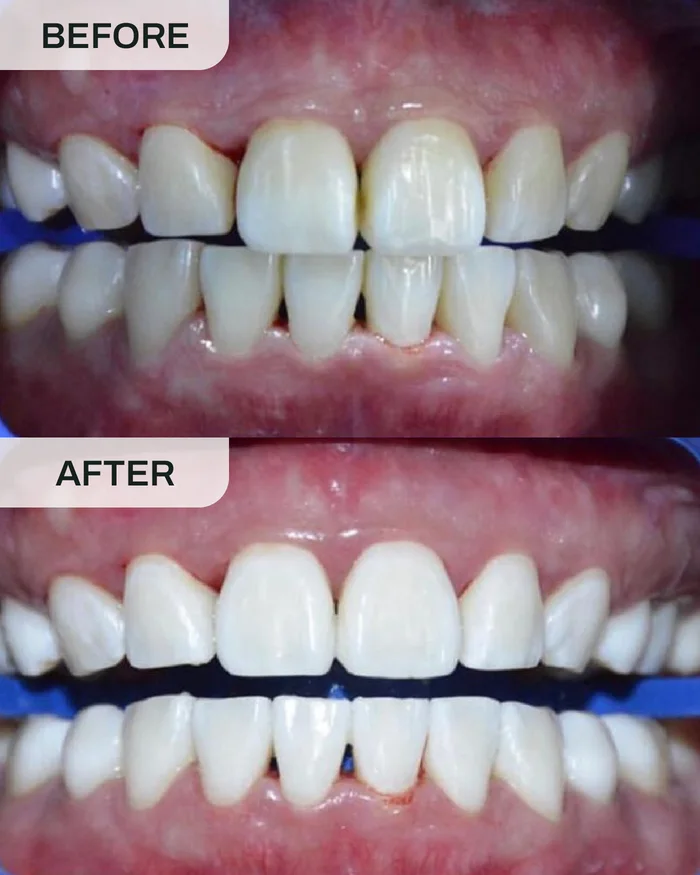 Teeth Whitening before and after result at Ivory Dental Kepong