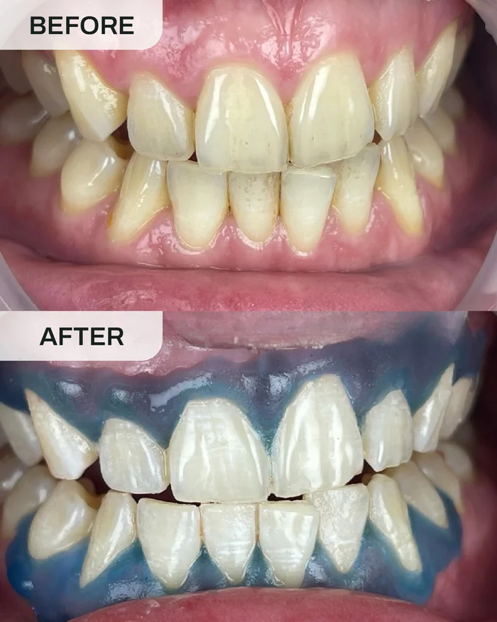 Teeth Whitening before and after result at Ivory Dental Kepong