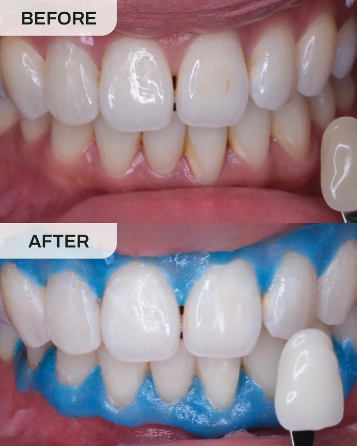 Teeth Whitening before and after result at Ivory Dental Kepong