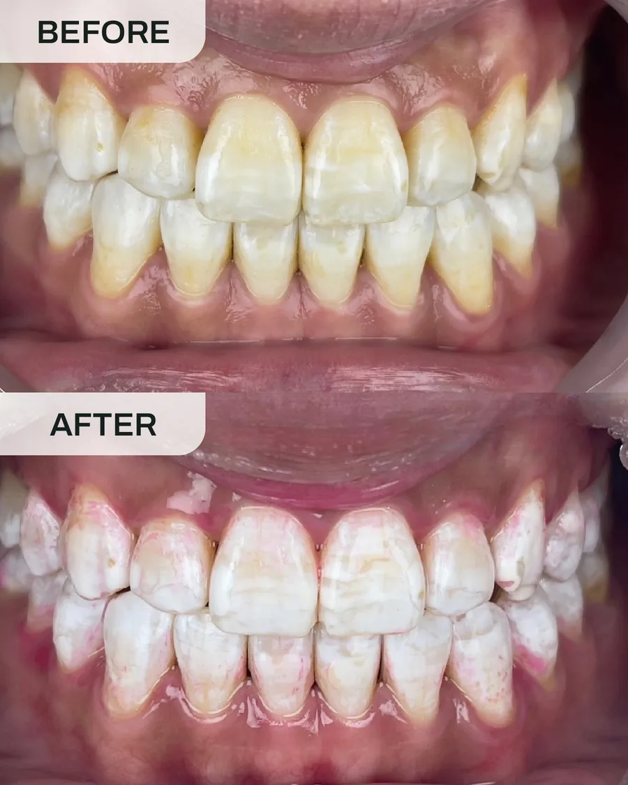 Teeth whitening before and after, case 4, at Ivory Dental Kepong