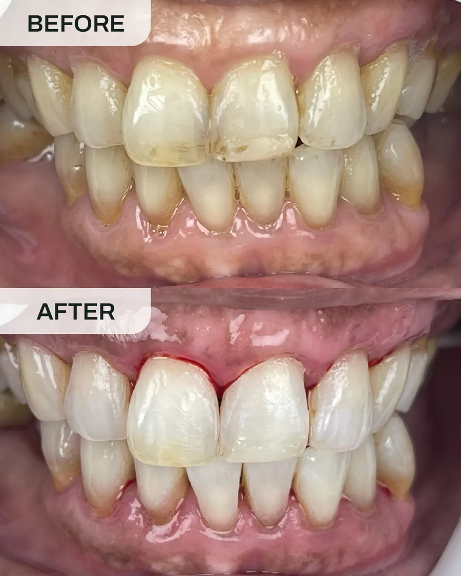 Teeth whitening before and after, case 5, at Ivory Dental Kepong