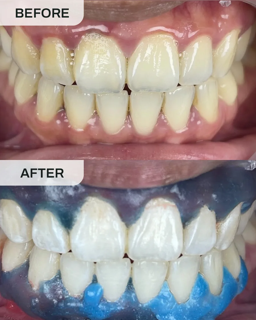 Teeth whitening before and after, case 6, at Ivory Dental Kepong