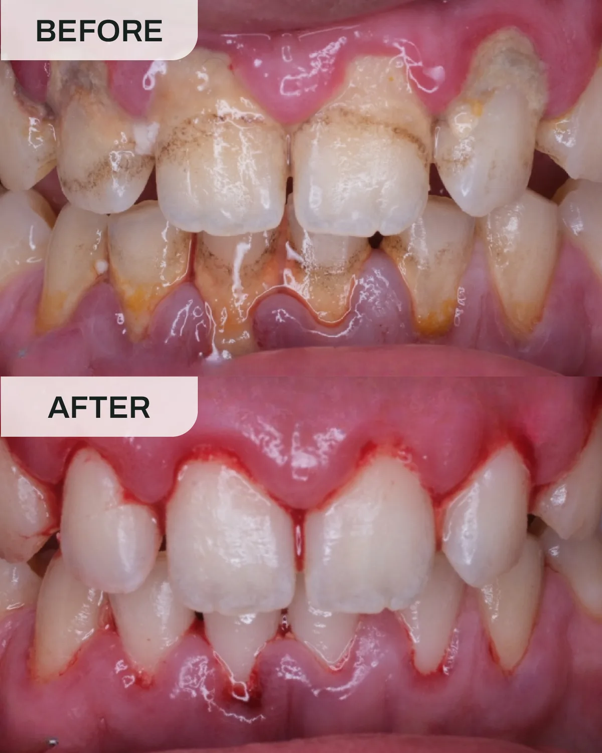 Gum treatment before and after results at Ivory Dental Kepong