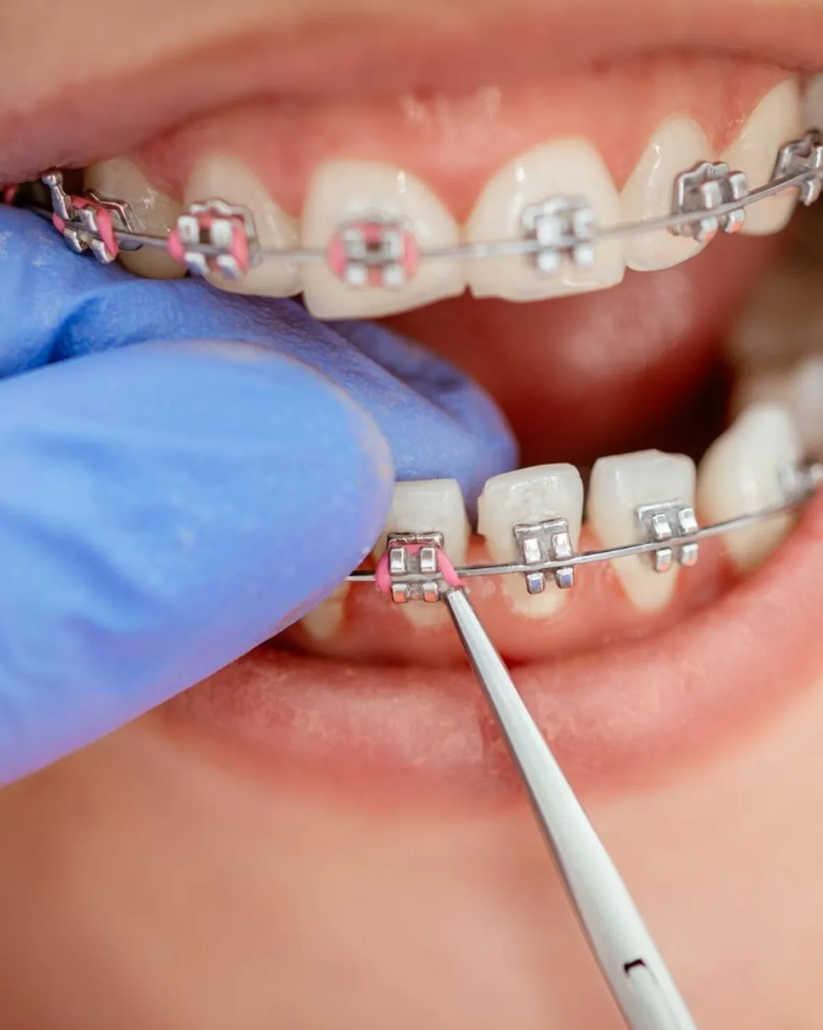 Braces adjustment close-up at Ivory Dental Kepong