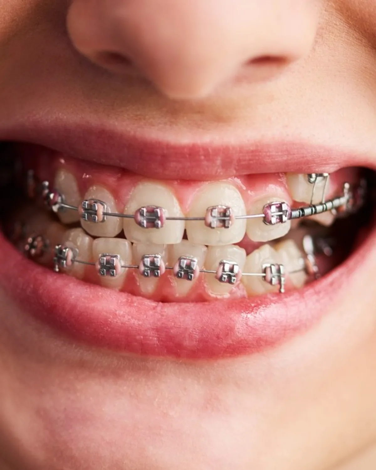 Braces close-up at Ivory Dental Kepong