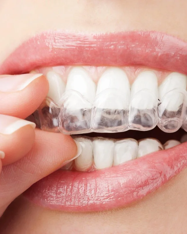Clear aligner being fitted at Ivory Dental Kepong