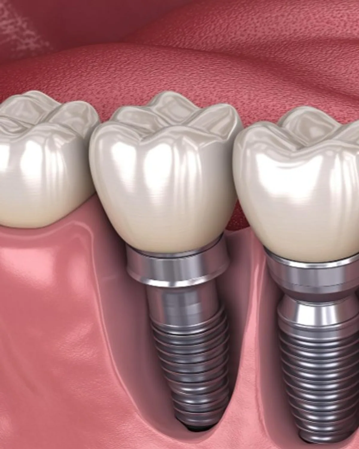 3D illustration of a dental implant at Ivory Dental Kepong