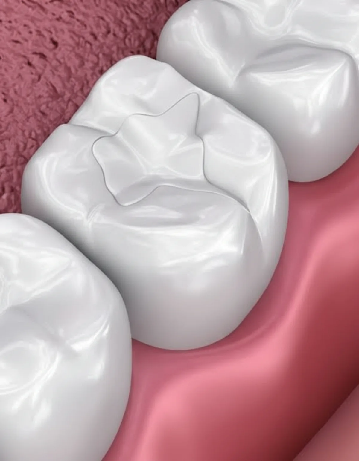 Completed dental filling illustration at Ivory Dental Kepong