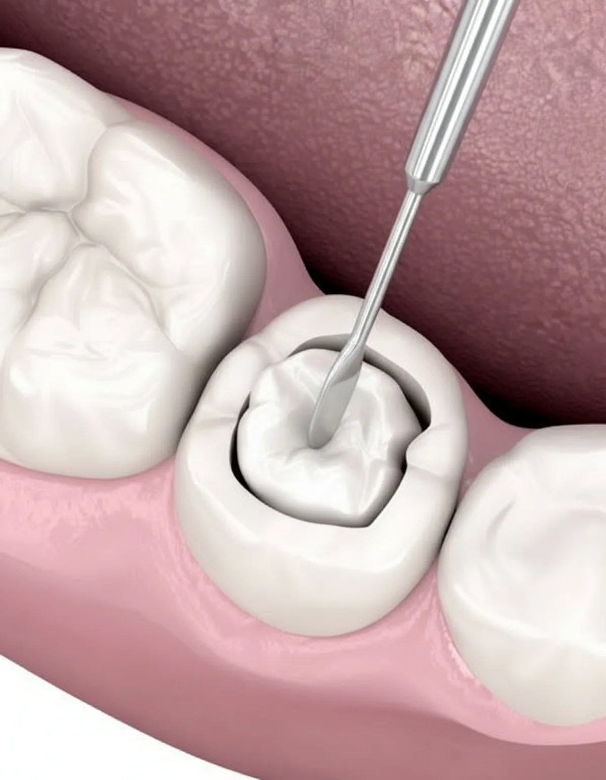 Dental filling placement illustration at Ivory Dental Kepong