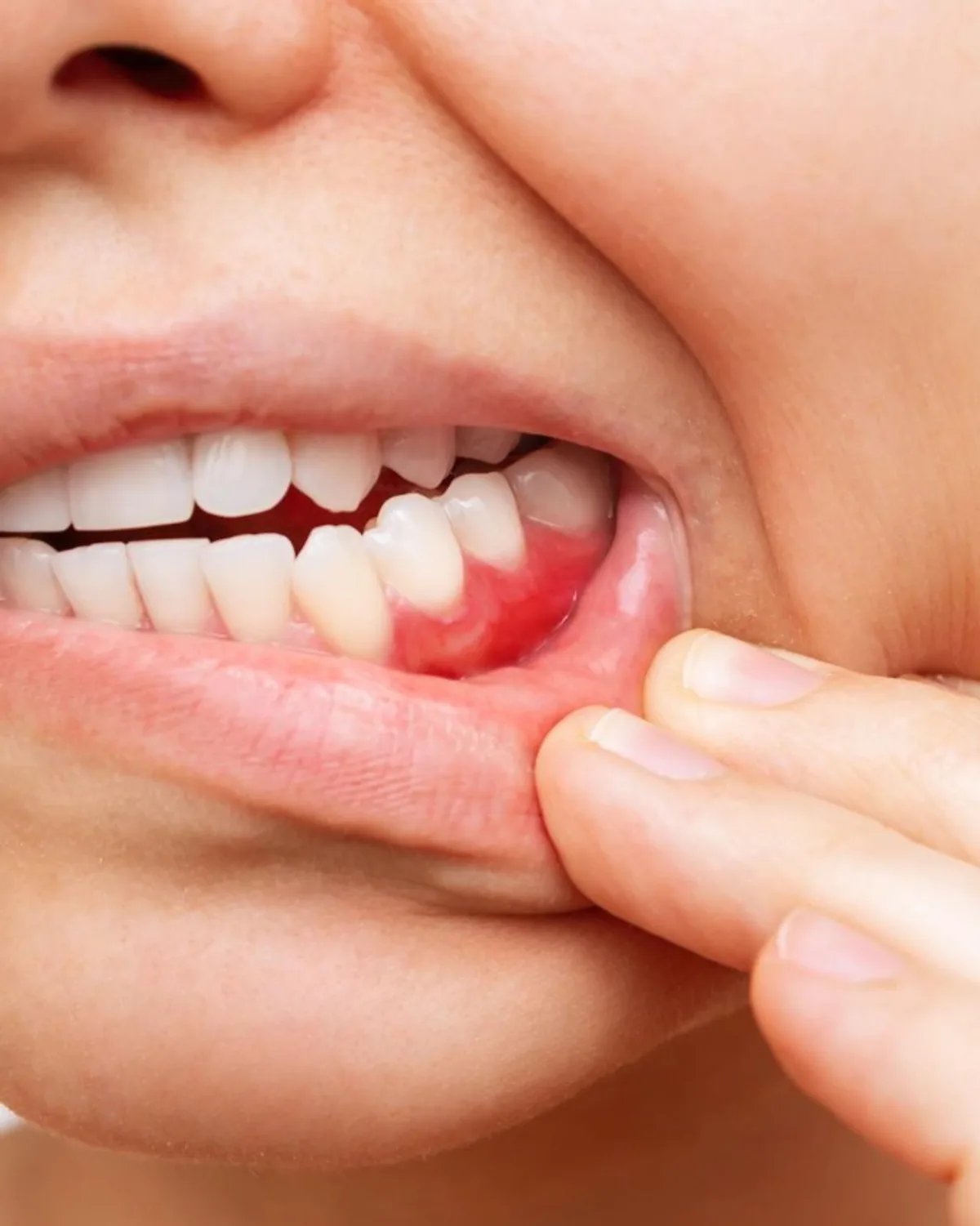 Gum treatment for gum inflammation at Ivory Dental Kepong