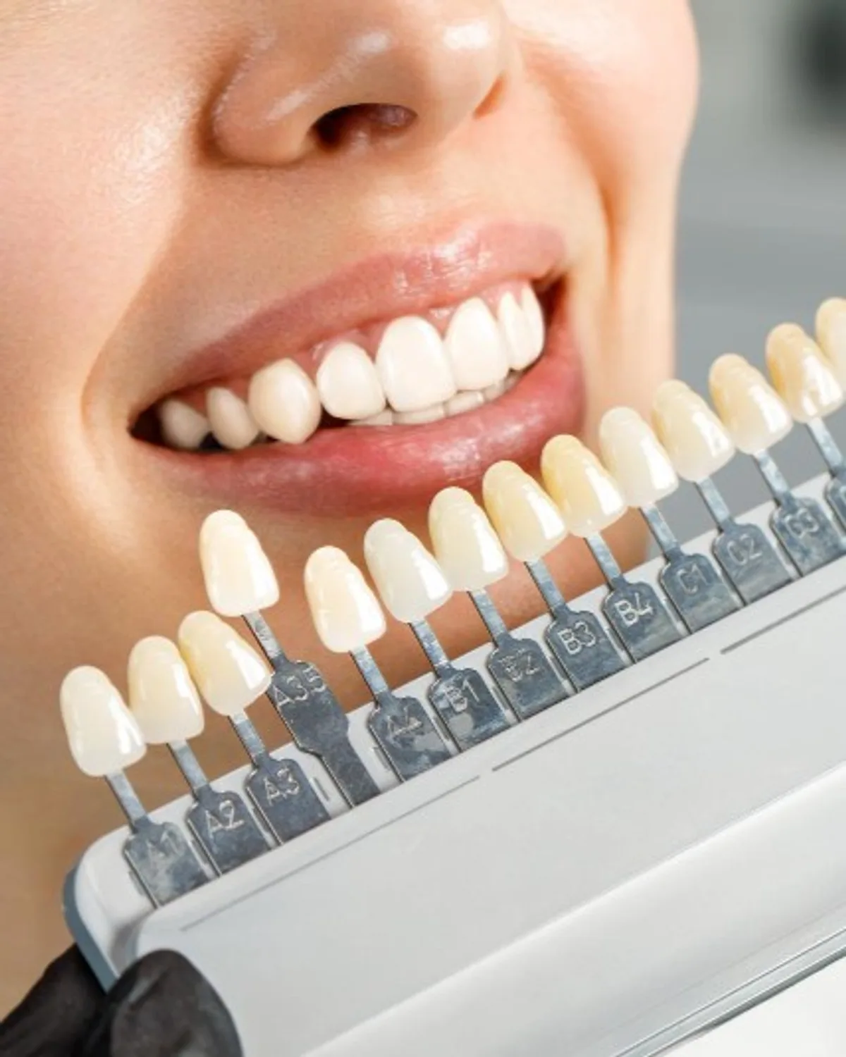 Teeth whitening shade matching at Ivory Dental Kepong