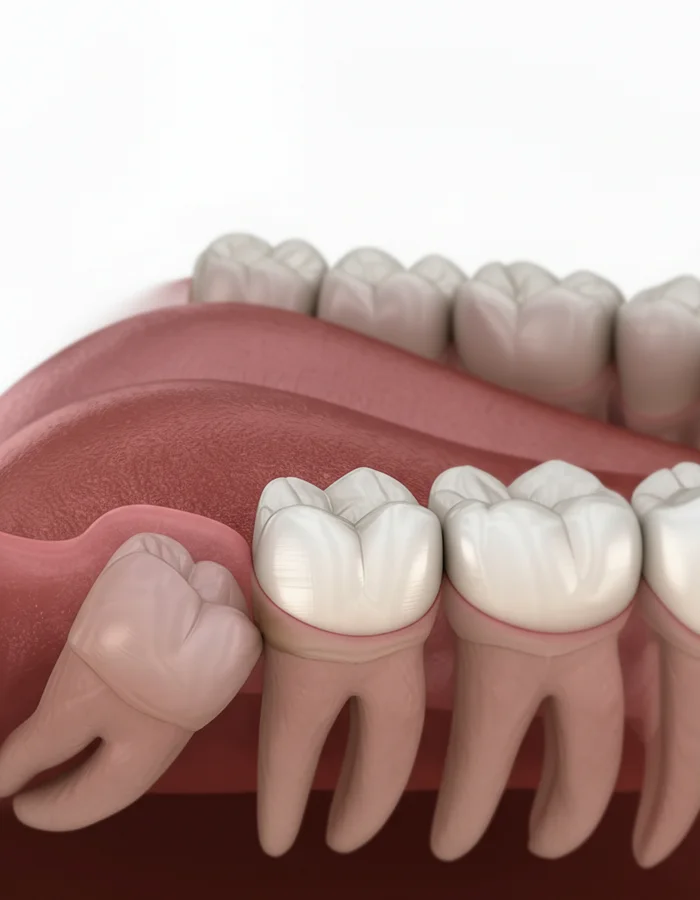 Wisdom tooth removal illustration, Ivory Dental Kepong